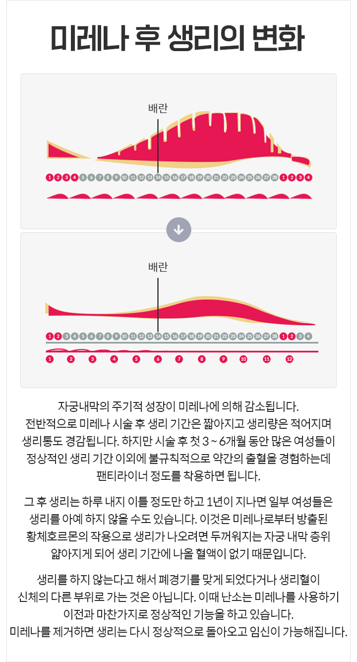 미레나 후 생리의 변화