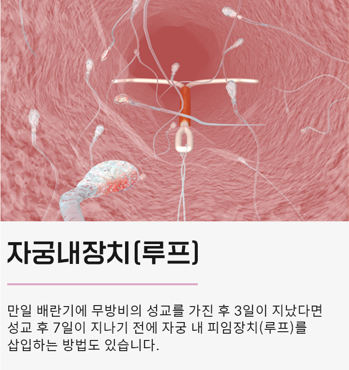 자궁내장치(루프)