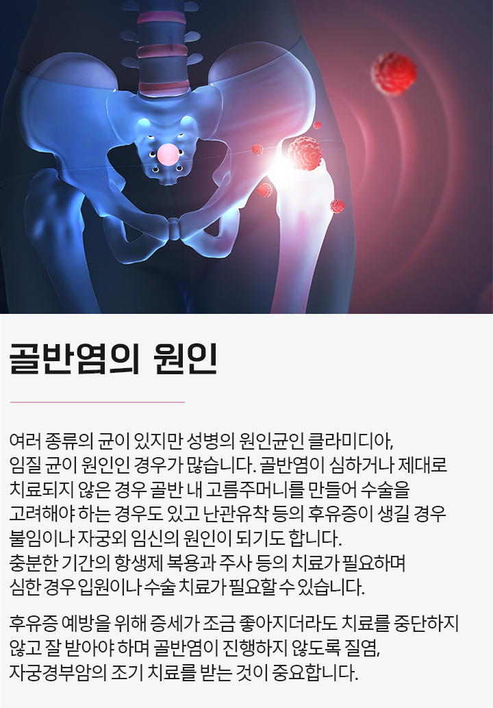 골반염 원인