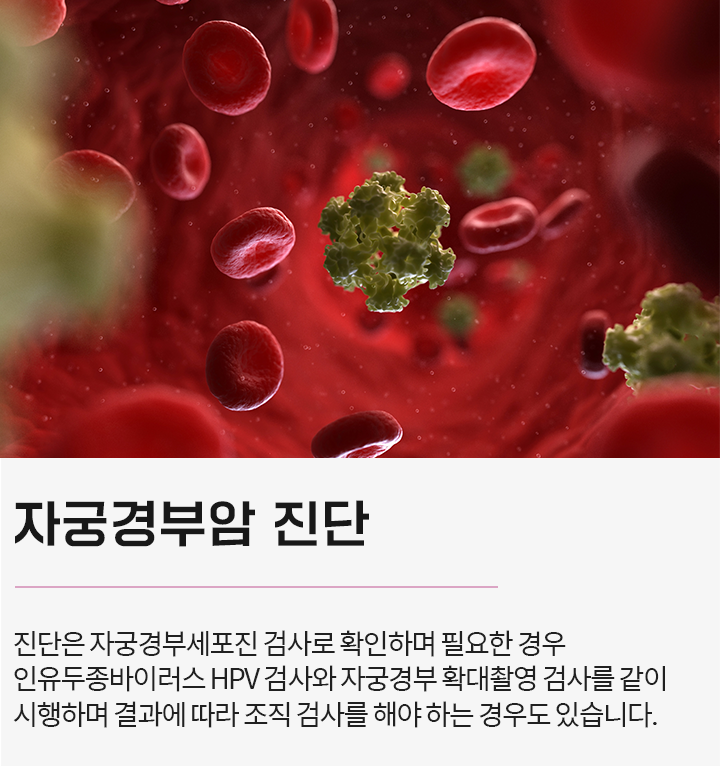 자궁경부암 진단